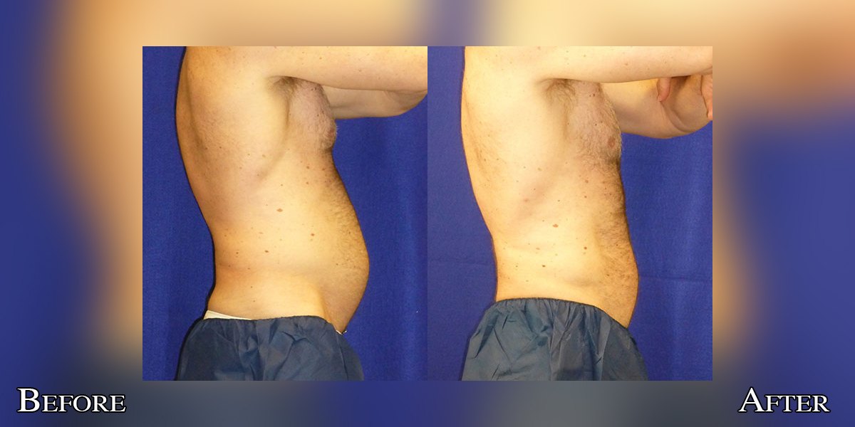 CryoLean before and after, abdomen, real male patient